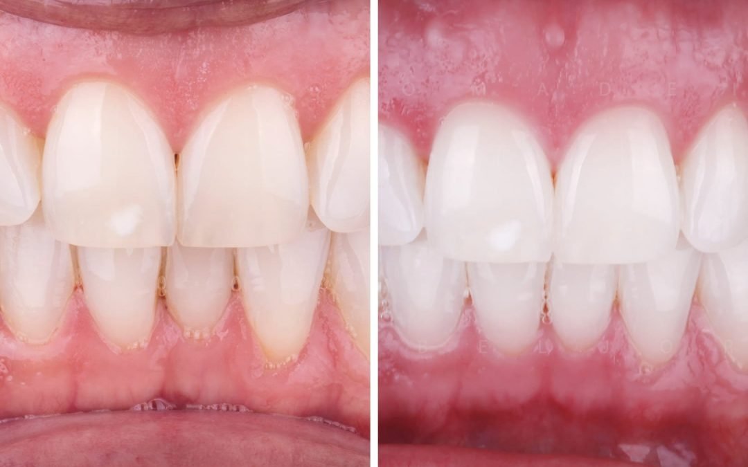 Verdades sobre Branqueamentos dentários
