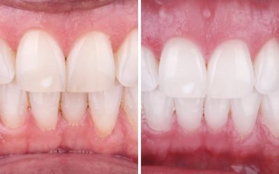 Verdades sobre Branqueamentos dentários