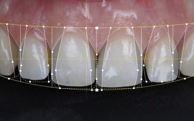 Redesenhar o sorriso – Facetas cerâmicas