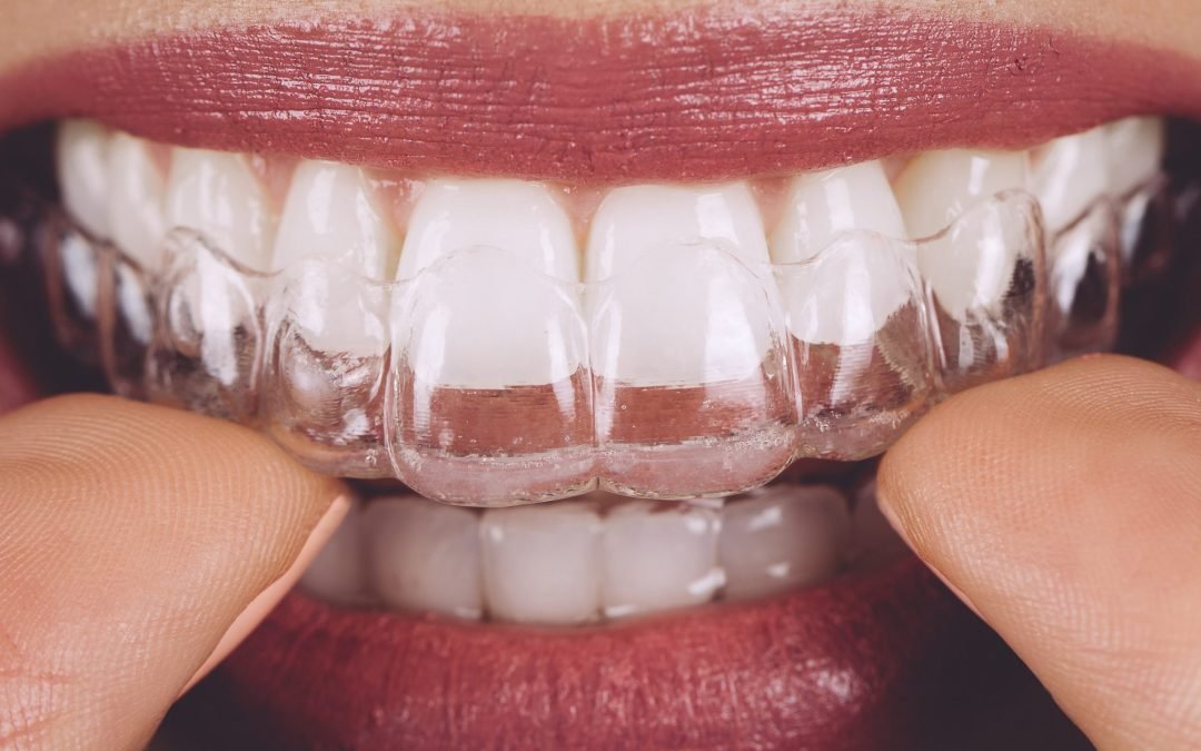 9 perguntas sobre a utilização do aparelho Invisalign®