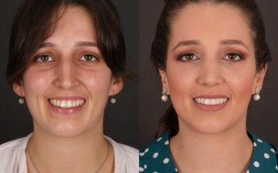 Sabe aquelas manchas brancas nos dentes? Explicamos-lhe como as removemos.