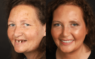 Um sorriso com prótese fixa sobre implantes dentários