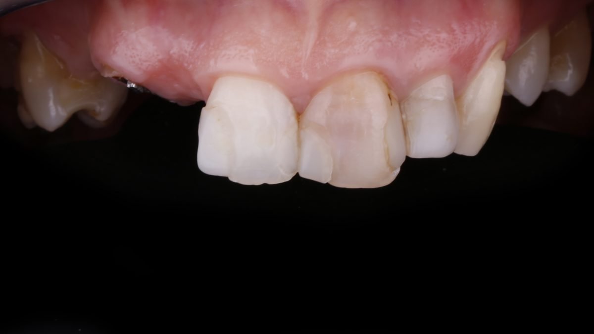 medo implantes dentários