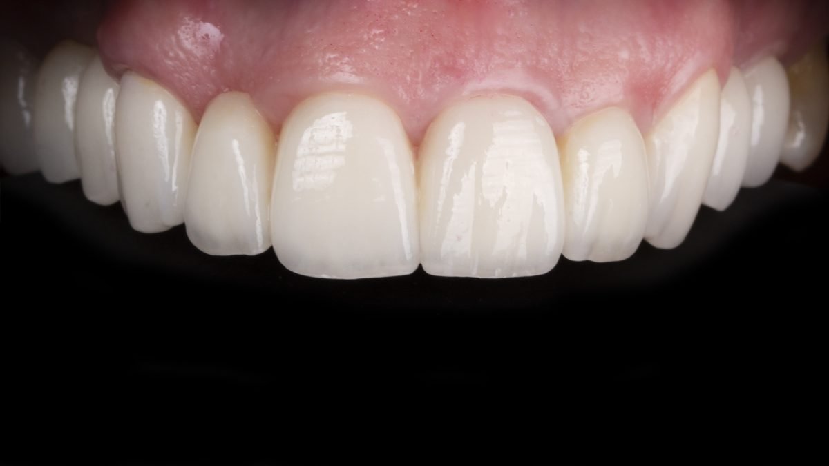 Intra-oral-depois-1200x675 (1)