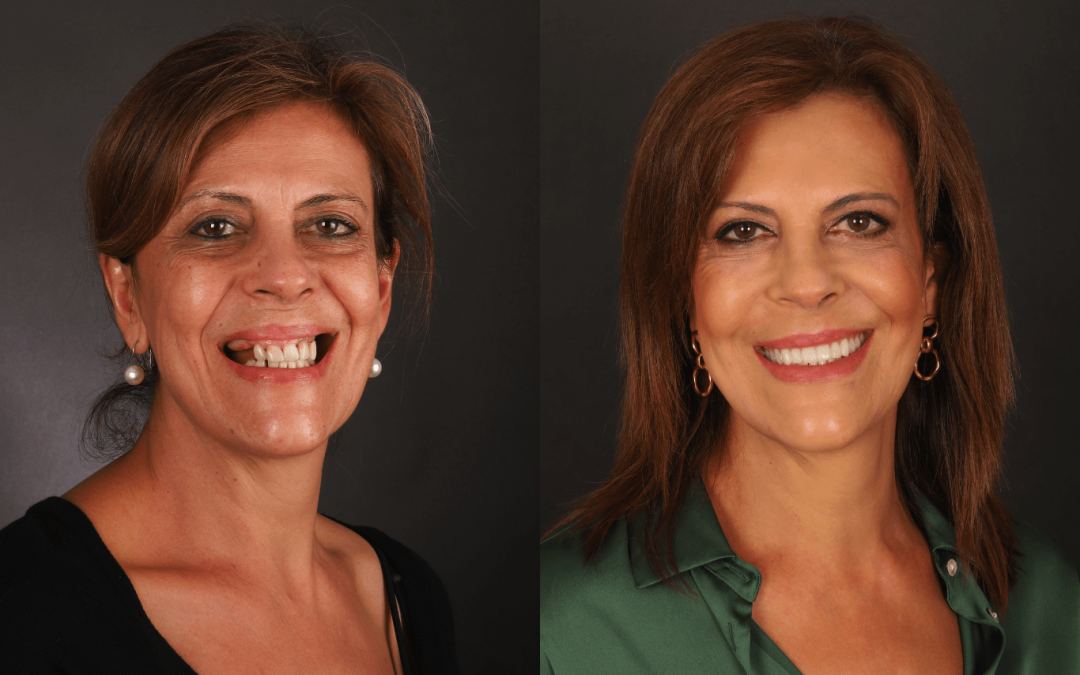 Implante Dentário: antes e depois da transformação