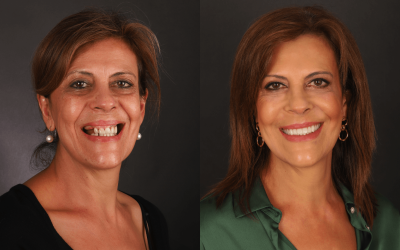 Implante Dentário: antes e depois da transformação