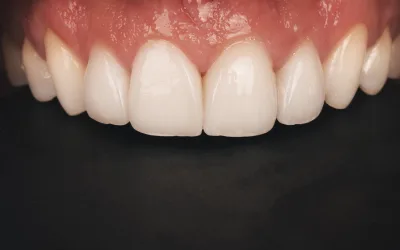 Remover facetas e coroas cerâmicas com Laser
